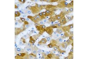 Immunohistochemical analysis of HAGH staining in human liver cancer formalin fixed paraffin embedded tissue section. (HAGH 抗体)