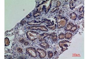 Immunohistochemistry (IHC) analysis of paraffin-embedded Human Prostate Cancer, antibody was diluted at 1:100. (ENPP3 抗体  (Internal Region))