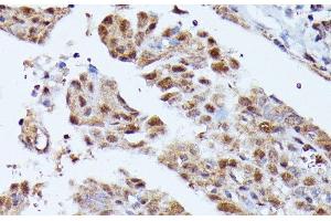 Immunohistochemistry of paraffin-embedded Human thyroid cancer using KIAA1429 Polyclonal Antibody at dilution of 1:100 (40x lens). (VIRMA/KIAA1429 抗体)