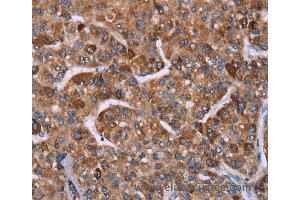 Immunohistochemistry of Human gastric cancer using HSPE1 Polyclonal Antibody at dilution of 1:40 (HSPE1 抗体)