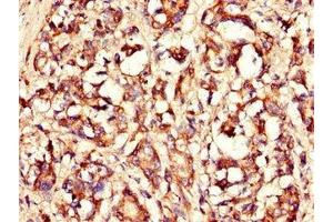 Immunohistochemistry of paraffin-embedded human gastric cancer using ABIN7158350 at dilution of 1:100 (LASP1 抗体  (AA 128-252))