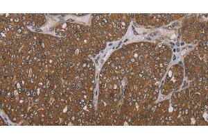 Immunohistochemistry of paraffin-embedded Human ovarian cancer tissue using FOLH1B Polyclonal Antibody at dilution 1:30 (FOLH1B 抗体)