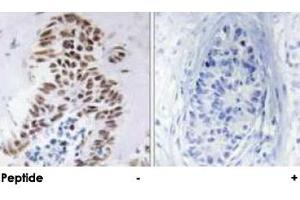 Immunohistochemical analysis of paraffin-embedded human lung carcinoma tissue using DAPK3 polyclonal antibody . (DAPK3 抗体)