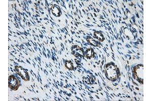 Immunohistochemical staining of paraffin-embedded Adenocarcinoma of breast tissue using anti-DCXR mouse monoclonal antibody. (DCXR 抗体)