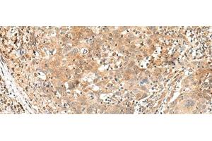 Immunohistochemistry of paraffin-embedded Human cervical cancer tissue using KCNA10 Polyclonal Antibody at dilution of 1:40(x200) (KCNA10 抗体)