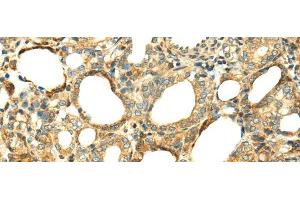 Immunohistochemistry of paraffin-embedded Human thyroid cancer tissue using SERPINA12 Polyclonal Antibody at dilution 1:40 (SERPINA12 抗体)