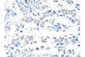 Immunohistochemistry of paraffin-embedded human lung cancer using MTA2 Antibody (ABIN4904441) at dilution of 1:100 (40x lens). (MTA2 抗体)