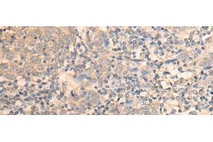 Immunohistochemistry of paraffin-embedded Human cervical cancer tissue using DAZ1 Polyclonal Antibody at dilution of 1:55(x200) (DAZ1 抗体)