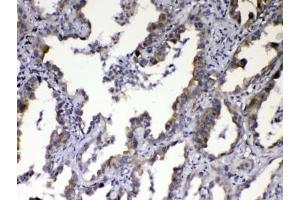IHC testing of FFPE human lung cancer tissue with CCN3 antibody at 1ug/ml. (NOV 抗体  (AA 334-357))