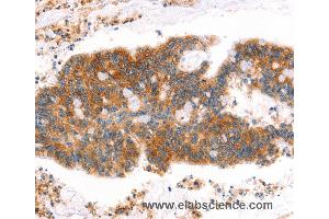 Immunohistochemistry of Human lung cancer using MLLT4 Polyclonal Antibody at dilution of 1:40 (Afadin 抗体)