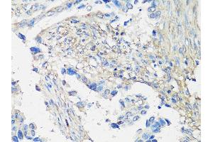 Immunohistochemistry of paraffin-embedded human lung cancer using MMP2 Antibody (ABIN5998246) at dilution of 1/100 (40x lens). (MMP2 抗体)