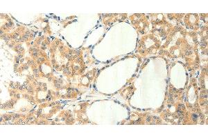 Immunohistochemistry of paraffin-embedded Human thyroid cancer using TRPM5 Polyclonal Antibody at dilution of 1:60 (TRPM5 抗体)