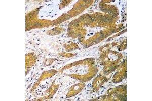Immunohistochemical analysis of p53 staining in human colon cancer formalin fixed paraffin embedded tissue section. (p53 抗体  (N-Term))
