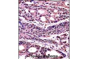 HMGB1 Antibody (C-term) (Ascites) (ABIN1536601)immunohistochemistry analysis in formalin fixed and paraffin embedded human colon carcinoma followed by peroxidase conjμgation of the secondary antibody and DAB staining. (HMGB1 抗体  (C-Term))