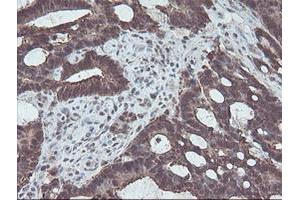 Immunohistochemical staining of paraffin-embedded Adenocarcinoma of Human colon tissue using anti-CBR3 mouse monoclonal antibody. (CBR3 抗体)