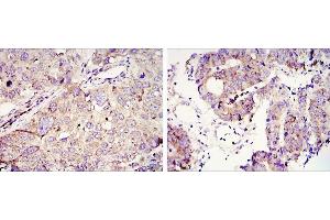 Immunohistochemical analysis of paraffin-embedded lung cancer (left) and colon tumour tissues (right) using IGC2BP3 mouse mAb with DAB staining.