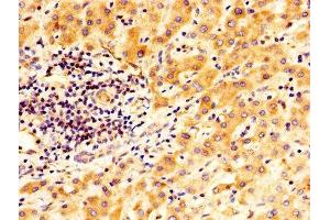 IHC image of ABIN7166409 diluted at 1:400 and staining in paraffin-embedded human liver cancer performed on a Leica BondTM system. (Transglutaminase 2 抗体  (AA 4-544))