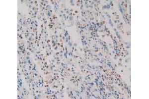 Used in DAB staining on fromalin fixed paraffin- embedded lung cancer tissue (HMGXB4 抗体  (AA 264-540))