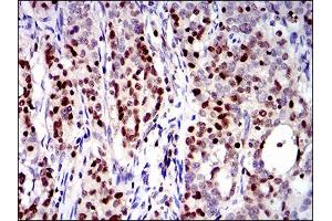 Immunohistochemical analysis of paraffin-embedded cervical cancer tissues using RUNX3 mouse mAb with DAB staining. (RUNX3 抗体  (AA 186-252))