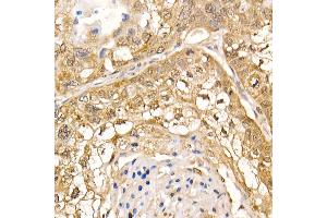Immunohistochemistry of paraffin-embedded human lung cancer using UBB Rabbit pAb (ABIN6130181, ABIN6149775, ABIN6149776 and ABIN6222958) at dilution of 1:200 (40x lens). (UBASH3B 抗体  (AA 1-300))