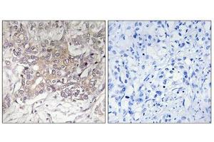 Immunohistochemistry analysis of paraffin-embedded human liver carcinoma tissue using GCNT3 antibody. (GCNT3 抗体  (Internal Region))