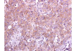 IHC-P Image TRAF5 antibody [N1N3] detects TRAF5 protein at cytoplasm on human breast carcinoma by immunohistochemical analysis. (TRAF5 抗体  (N-Term))