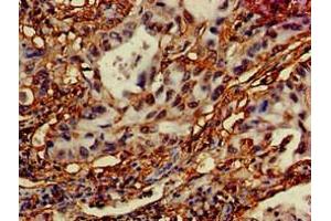 Immunohistochemistry of paraffin-embedded human lung cancer using ABIN7150140 at dilution of 1:100 (DRAM 抗体  (AA 50-100))