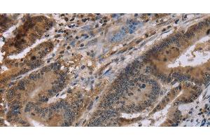 Immunohistochemistry of paraffin-embedded Human colon cancer tissue using FAM107A Polyclonal Antibody at dilution 1:30 (FAM107A 抗体)