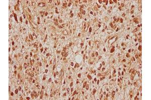 IHC image of ABIN7170677 diluted at 1:100 and staining in paraffin-embedded human glioma cancer performed on a Leica BondTM system. (SRPK2 抗体  (AA 471-688))