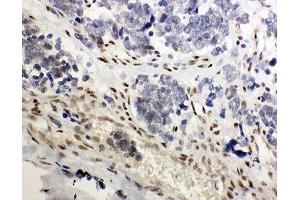 IHC-P: GR antibody testing of human lung cancer tissue (GR (AA 20-199) 抗体)