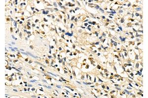 ABIN6260794 and ABIN6278439 at 1/100 staining Human colorectal cancer by IHC-P.