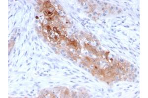 Formalin-fixed, paraffin-embedded human Bladder Carcinoma stained with Desmoglein-1 Mouse Monoclonal Antibody (32-2B). (Desmoglein 1 抗体)
