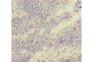 Immunohistochemistry of paraffin-embedded human colon cancer using ABIN7152525 at dilution of 1:100 (FOXRED1 抗体  (AA 307-486))