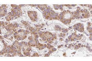 ABIN6273985 at 1/100 staining Human liver cancer tissue by IHC-P. (OR2V2 抗体  (Internal Region))