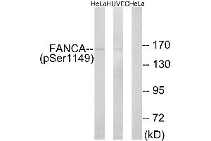 Immunohistochemistry analysis of paraffin-embedded human colon carcinoma tissue using FANCA (Phospho-Ser1149) antibody. (FANCA 抗体  (pSer1149))