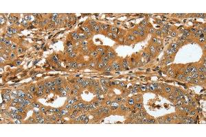 Immunohistochemistry of paraffin-embedded Human gastric cancer tissue using RAP1A Polyclonal Antibody at dilution 1:45 (RAP1A 抗体)