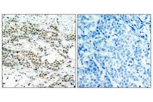 Immunohistochemical analysis of paraffin-embedded human breast carcinoma tissue using AFX(Phospho-Ser197) Antibody(left) or the same antibody preincubated with blocking peptide(right). (FOXO4 抗体  (pSer197))