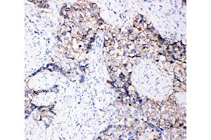 Anti-Eph receptor B3 antibody, IHC(P) IHC(P): Human Lung Cancer Tissue (EPH Receptor B3 抗体  (C-Term))