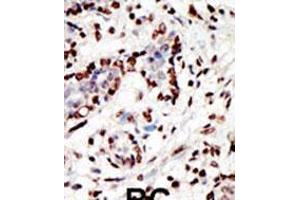 Formalin-fixed and paraffin-embedded human cancer tissue reacted with the primary antibody, which was peroxidase-conjugated to the secondary antibody, followed by AEC staining. (MLL/KMT2A 抗体  (C-Term))