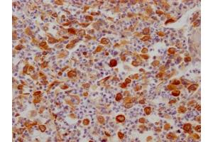 IHC image of ABIN7127486 diluted at 1:100 and staining in paraffin-embedded human lung cancer performed on a Leica BondTM system. (Recombinant FDFT1 抗体)