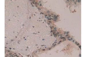 Detection of HDGF in Human Prostate Tissue using Polyclonal Antibody to Hepatoma Derived Growth Factor (HDGF) (HDGF 抗体  (AA 10-240))