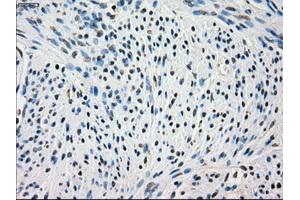 Immunohistochemical staining of paraffin-embedded Adenocarcinoma of colon tissue using anti-FRKmouse monoclonal antibody. (FRK 抗体)