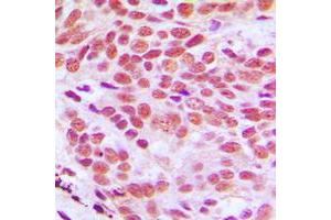 Immunohistochemical analysis of Histone H2B staining in human breast cancer formalin fixed paraffin embedded tissue section. (Histone H2B 抗体  (N-Term))
