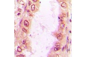 Immunohistochemical analysis of Sm-D2 staining in human lung cancer formalin fixed paraffin embedded tissue section. (SNRPD2 抗体)