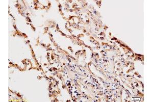 Formalin-fixed and paraffin embedded human lung labeled with Anti-Beta-HCG/HCG beta Polyclonal Antibody, Unconjugated  at 1:200, followed by conjugation to the secondary antibody and DAB staining (HCG beta 抗体  (AA 81-165))