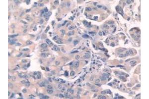 IHC-P analysis of Human Breast Cancer Tissue, with DAB staining. (Fibronectin 抗体  (AA 313-607))