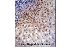 CCDC36 Antibody (C-term) (ABIN655696 and ABIN2845150) immunohistochemistry analysis in formalin fixed and paraffin embedded human esophageal carcinoma followed by peroxidase conjugation of the secondary antibody and DAB staining. (CCDC36 抗体  (C-Term))