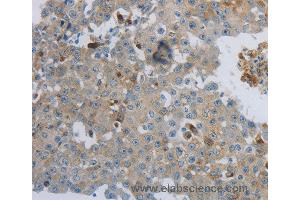 Immunohistochemistry of Human lung cancer using CKMT1A/CKMT1B Polyclonal Antibody at dilution of 1:100 (CKMT1A 抗体)