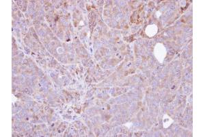 IHC-P Image Immunohistochemical analysis of paraffin-embedded SW480 xenograft , using Steroid sulfatase , antibody at 1:100 dilution. (STS 抗体)