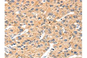 The image on the left is immunohistochemistry of paraffin-embedded Human liver cancer tissue using ABIN7192531(SLC8B1 Antibody) at dilution 1/20, on the right is treated with synthetic peptide. (SLC24A6 抗体)